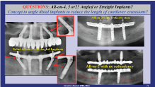 dr.niznick controversal questions in implant dentistry on nobel all on 3